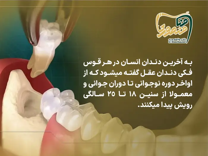 جراحی دندان عقل