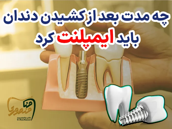 بهترین زمان ایمپلنت بعد از کشیدن دندان