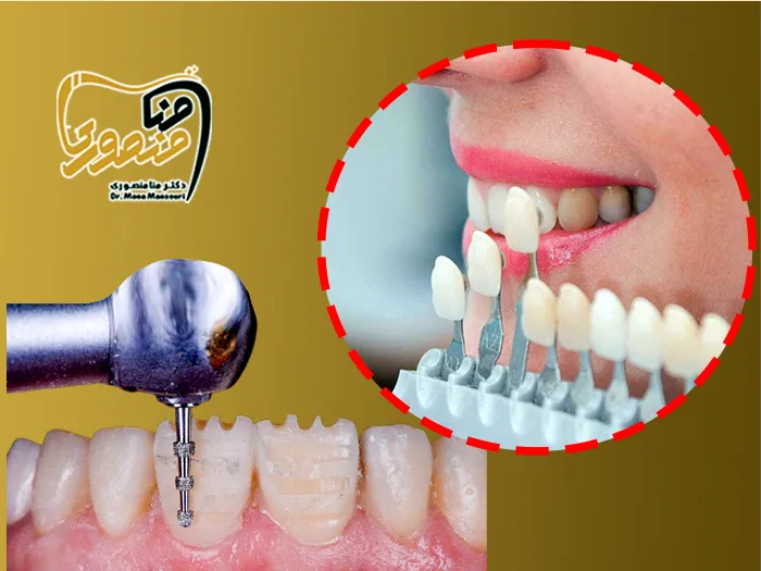 کامپوزیت بدون تراش دندان