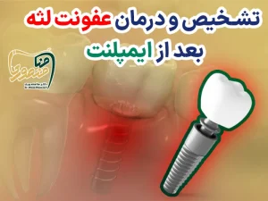درمان عفونت لثه بعد ایمپلنت