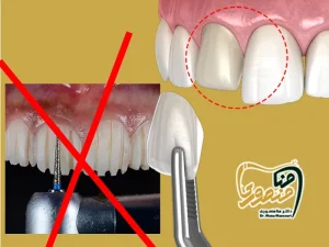 کامپوزیت دندان بدون تراش
