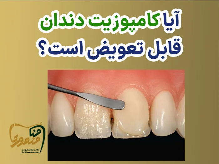 تعویض کامپوزیت دندان