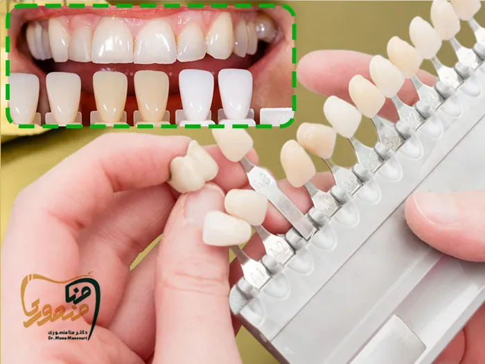 رنگ لمینت دندان