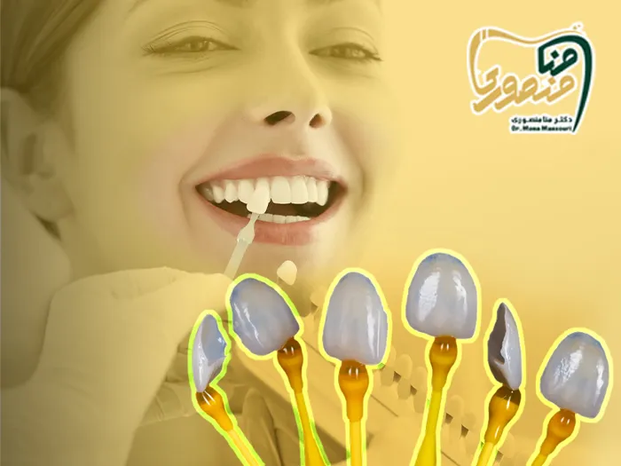 طول عمر لمینت دندان