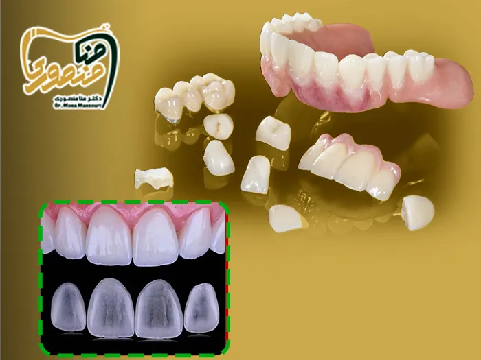 کامپوزیت آی پی اس
