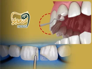 ترمیم کامپوزیت دندان