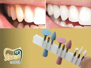 پولیش دندان کامپوزیت