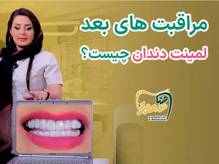 اقدامات بعد لمینت دندان