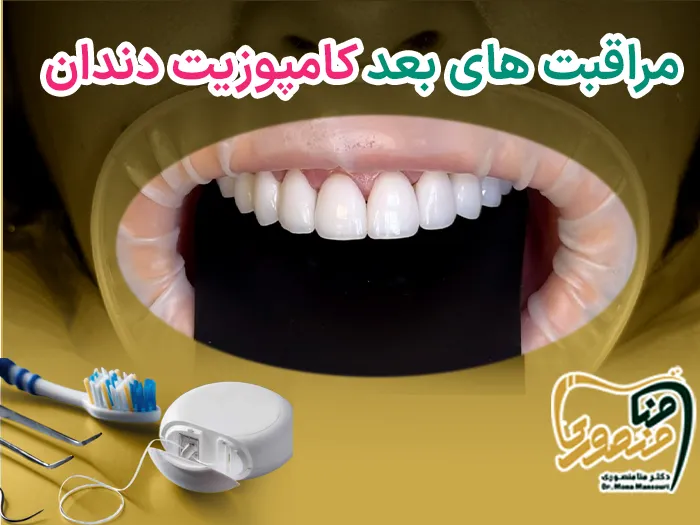 مراقبت های بعد کامپوزیت دندان