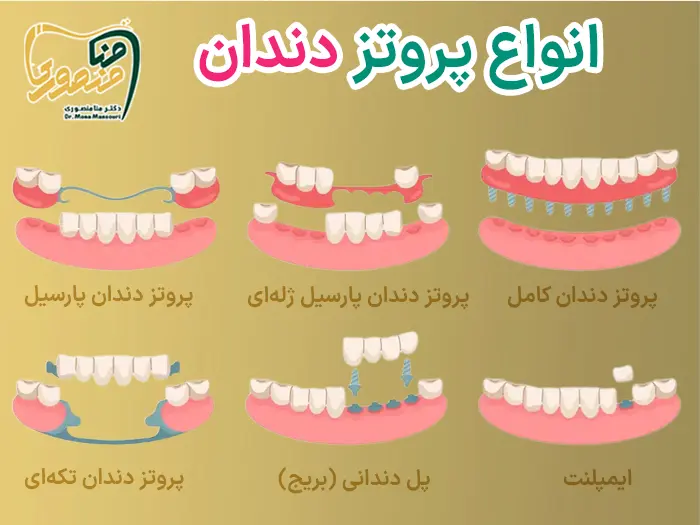 انواع پروتز دندان