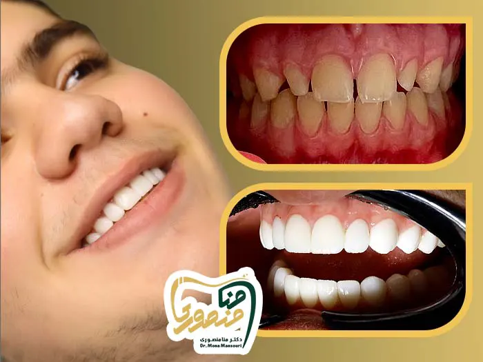 روکش سرامیکی دندان