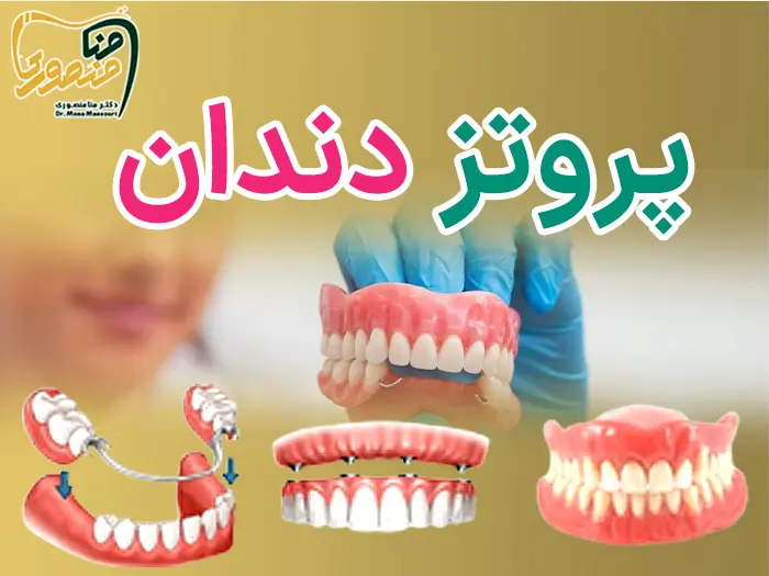 پروتز دندان