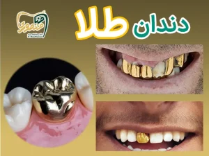 دندان طلا