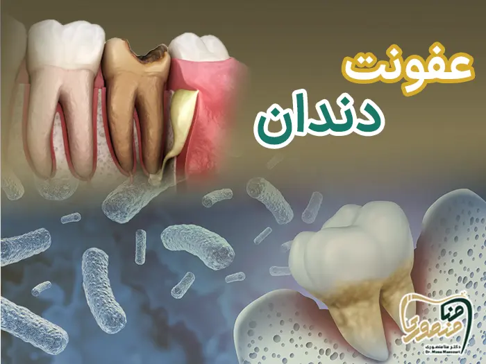 عفونت دندان