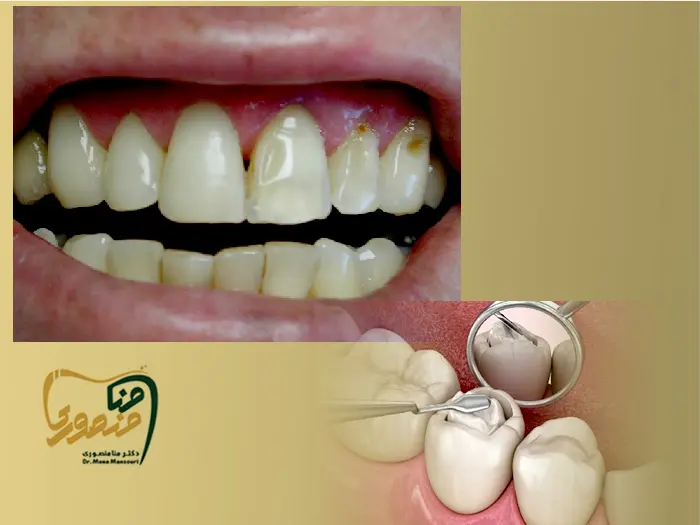 کامپوزیت دندان پوسیده جلو