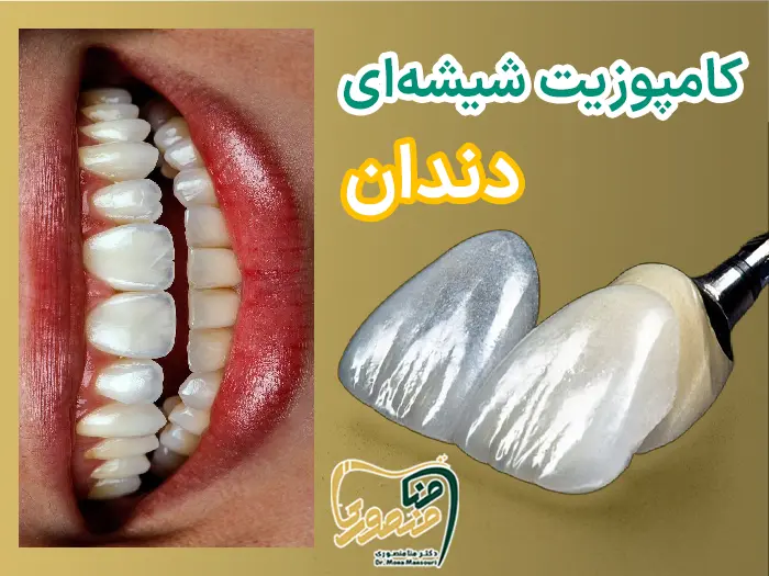 کامپوزیت لبه شفاف شیشه ای