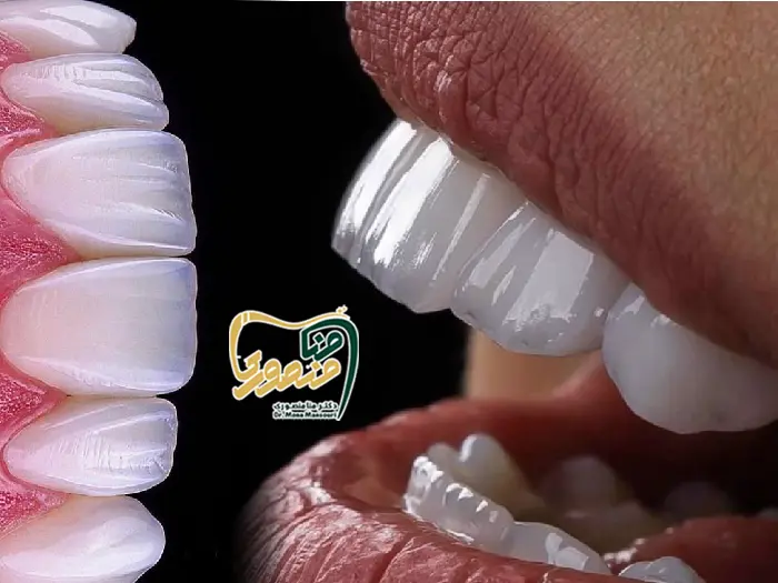 کاپوزیت شیشه ای لبه شفاف