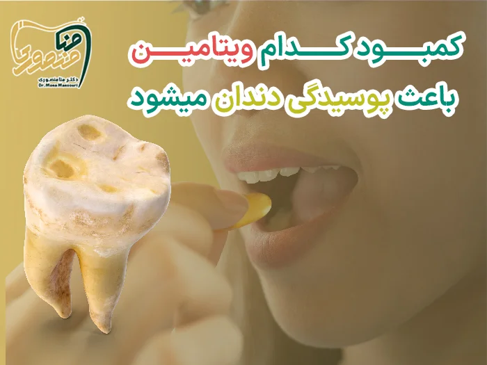 پوسیدگی دندان در اثر کمبود ویتامین
