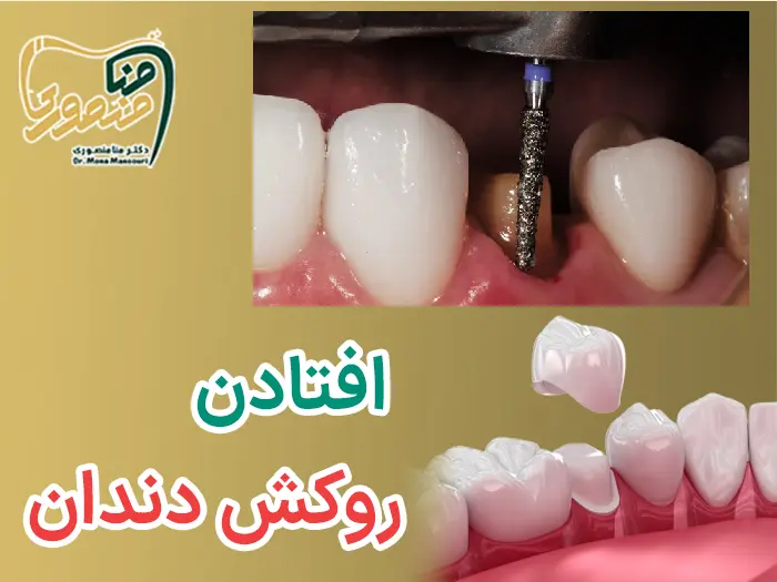 افتادن روکش دندان
