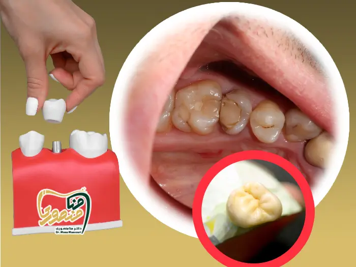 درآمدن روکش دندان