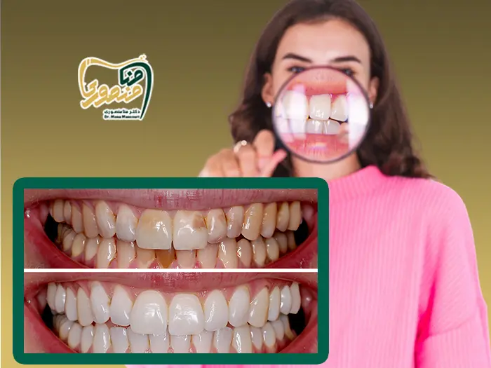 رفع زردی دندان در یک روز