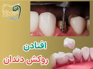 افتادن روکش دندان