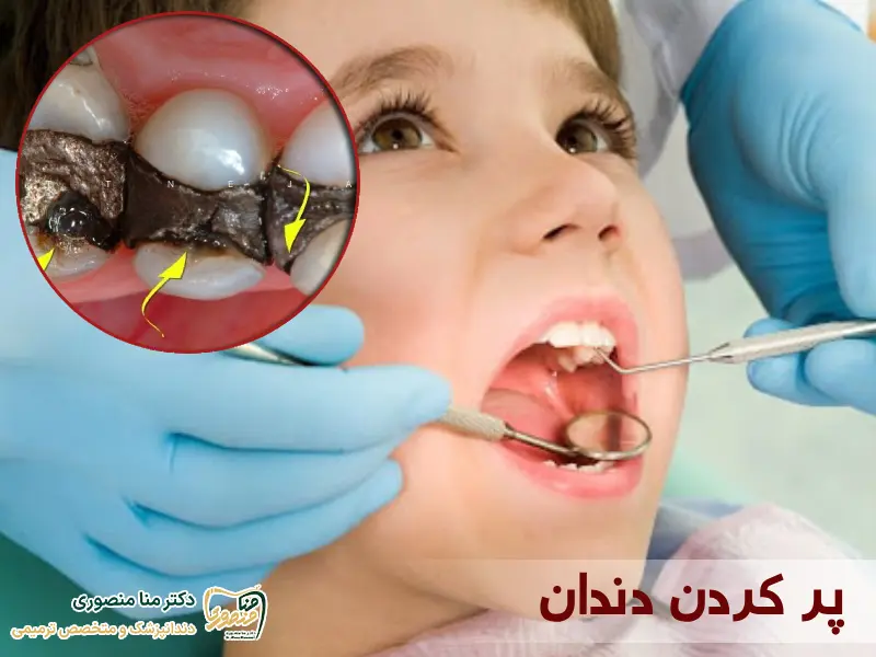 ترمیم و پر کردن دندان