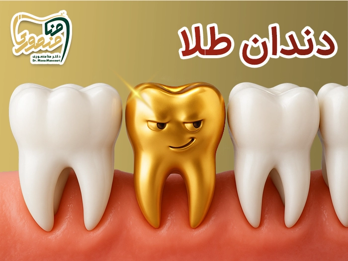 کاشت دندان طلا
