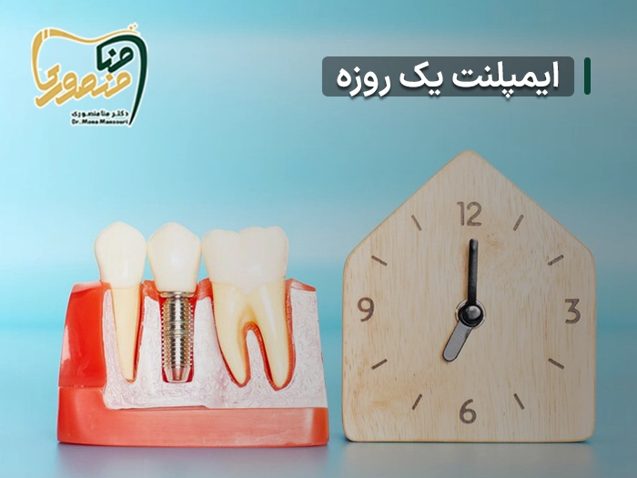 ایمپلنت یک روزه دندان