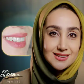 لمینت دیجیتالی دندان