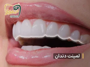 فیلم لمینت دندان