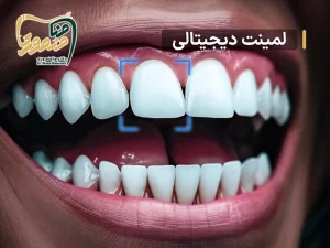 لمینت دیحیتالی