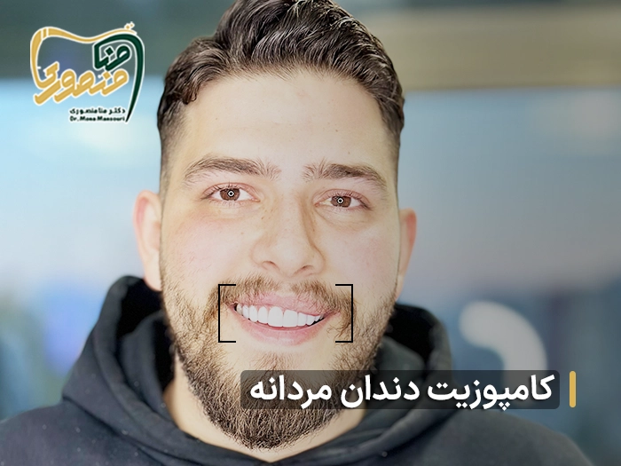 کامپوزیت دندان مردانه